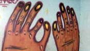 renal | mexico (4 votes)
